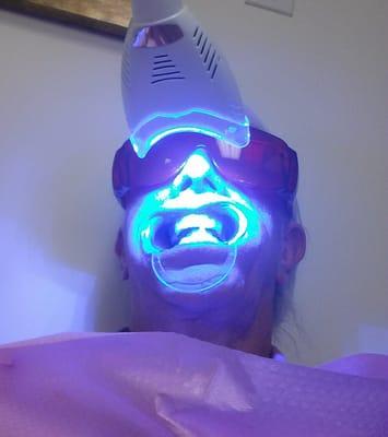 Laser whitening