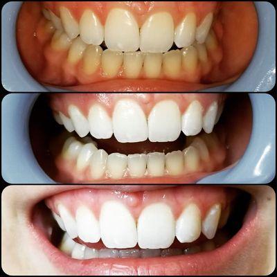 Three Session Teeth Whitening