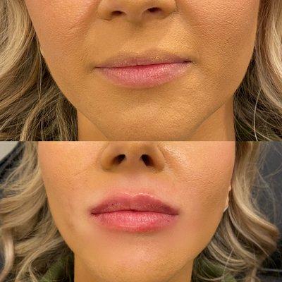 Lip filler. Beautiful, full, and natural results