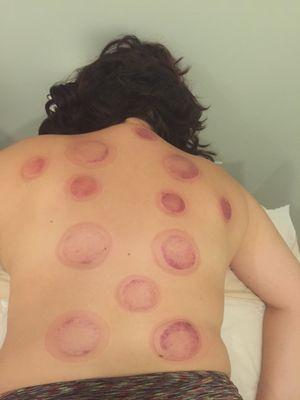 Cupping for acute back pain.