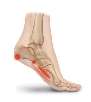 Plantar Fasciitis Pain Map