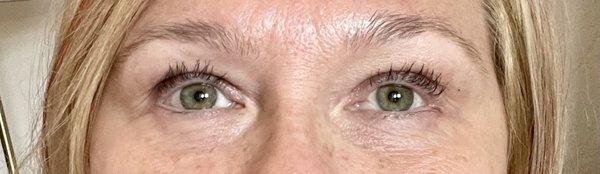 2 months after surgery lower eyelid fat removal