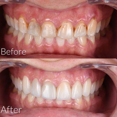 Before and after using Emax veneers