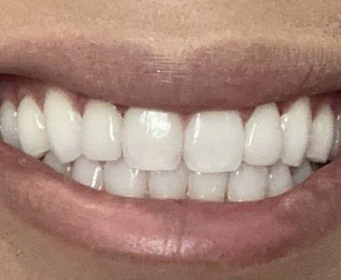 After Invisalign and porcelain veneers