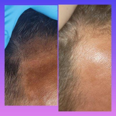 PRP hair treatment