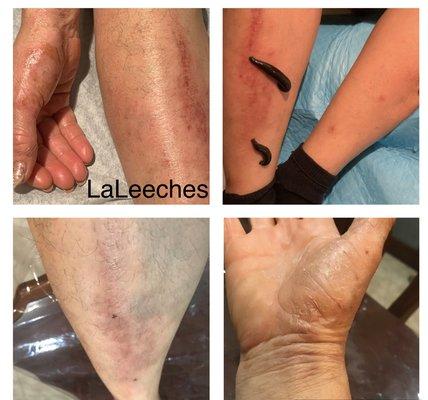 Treatment of itchy, irritates skin