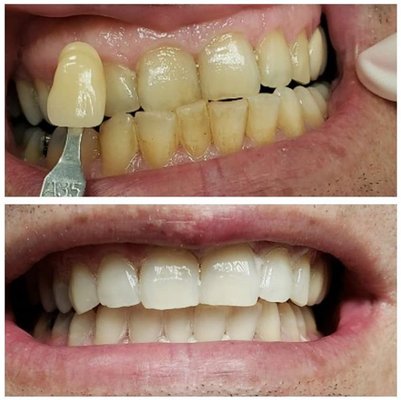 1 hour In-Office Bleaching. Smile with Confidence!