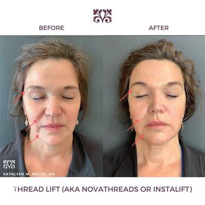 Threadlift with Dr. Welsh.