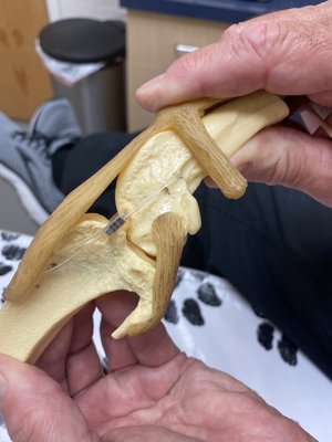 A model showing ACL implant repair