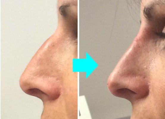 Nose filler