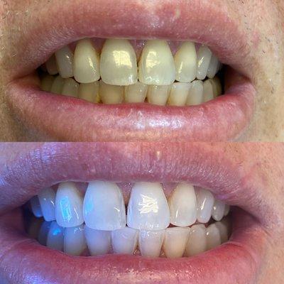 Laser Teeth Whitening