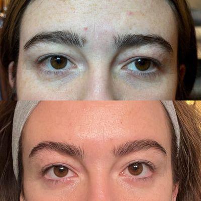 Botox Eyebrow Lift