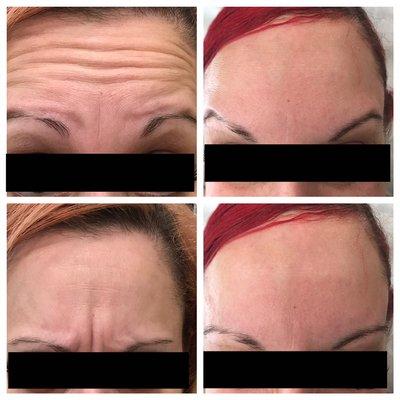 Relax facial lines with Botox