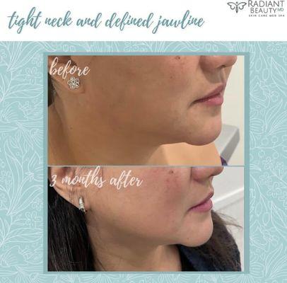 ULTHERAPY Skin tightening