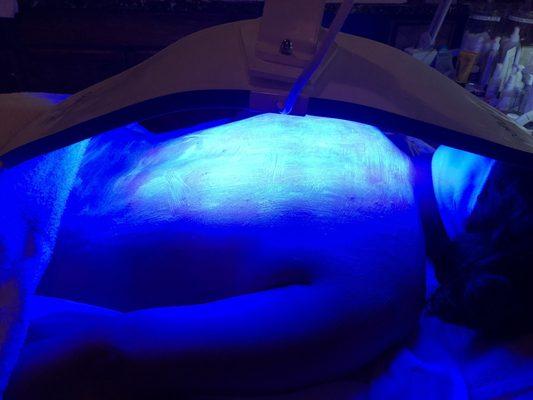 LED Back Acne Treatment - Advance Technology- Years of Experience - The Best In Sherman Oaks!