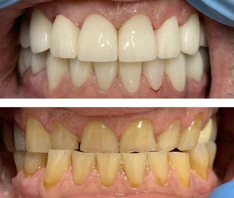 Full mouth crowns done by Dr.Yulia N