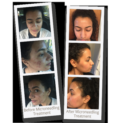 Microneedling