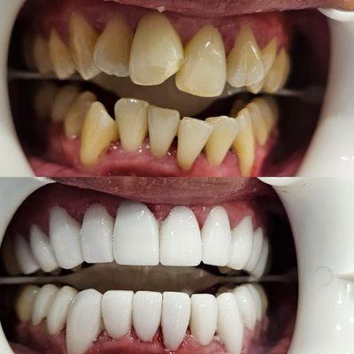 Patients bite fixed with a beautiful porcelain veneers