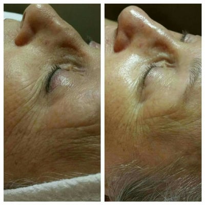 Before and after of our customized Vitamin C Infusion /Restorative facial