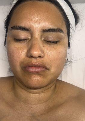 Results after dermaplaning facial