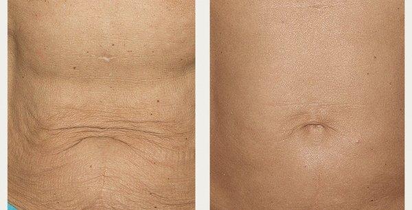 Thermage body tightening treatment