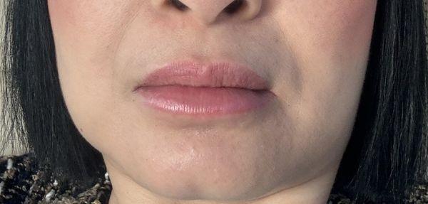 Right before but after many years lips done with doctor Han