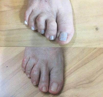 Before and After Surgical Hammertoe Correction