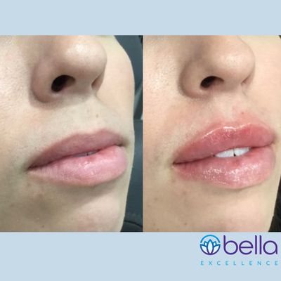 Just a half syringe for the upper lip to add balance to her lower lip. She loves her natural looking results.