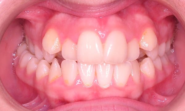 Wang Orthodontic Patient "B" Before