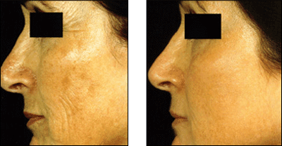 Fraxel Laser Treatment