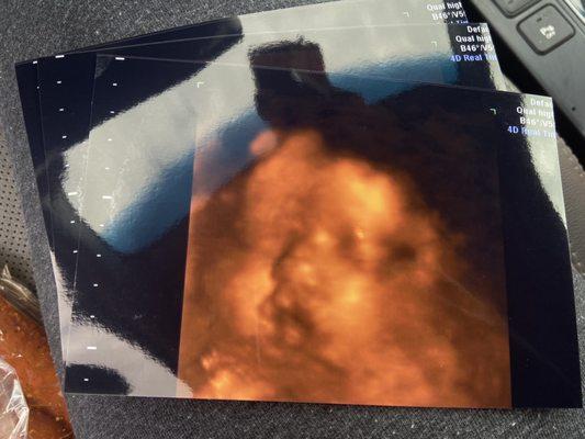 baby 3d/4d sonogram