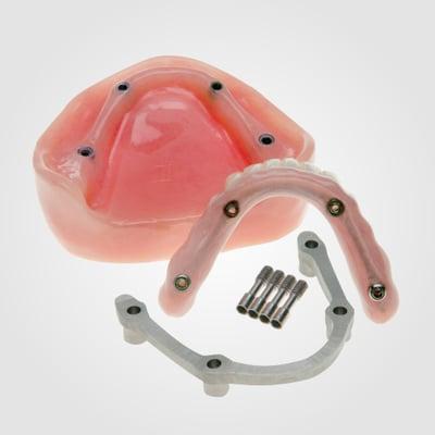 Screw-Retained Hybrid Denture