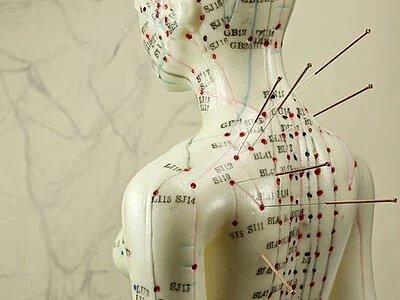 Acupuncture needles