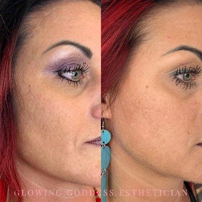 Microneedling, Texture & acne scarring