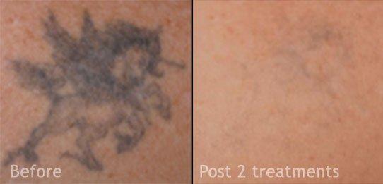 Laser Tattoo Removal NYC - Before & After