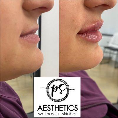 Lip fillers in Edmond