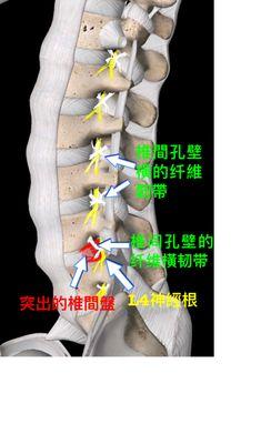 Transforaminal endoscopic can see the foramenal transverse ligament