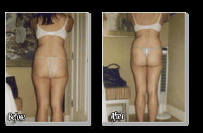 No Lipo Lipo before and after