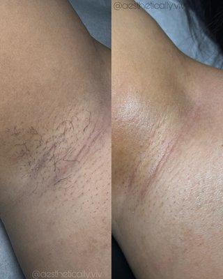 Underarm wax