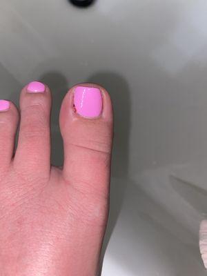 Infected toe nail