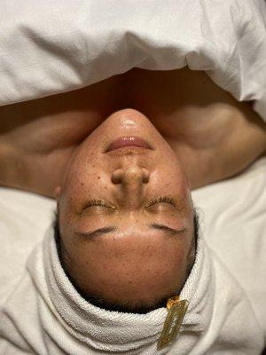 Glow after microdermaplaining and lactic acid peel