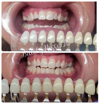 60 minute teeth whitening for this client !!