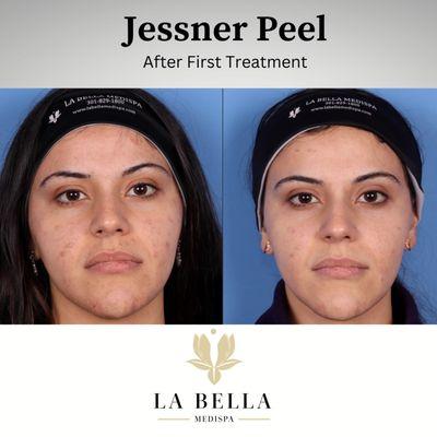 Jessner Peel before and after treatment