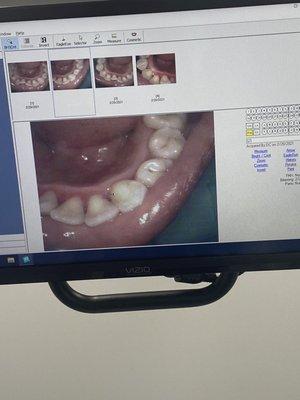 My after shots! Dr. Nihn was so thorough and gentle. He numbed my mouth at my request and got down to business!