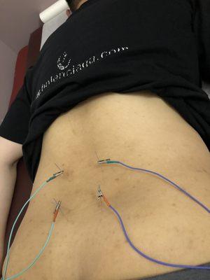 electric into muscles via acupuncture needles