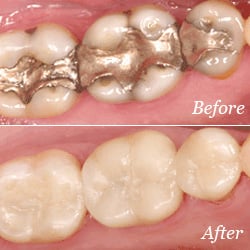 Replace large, old fillings with crowns for better function and esthetics.