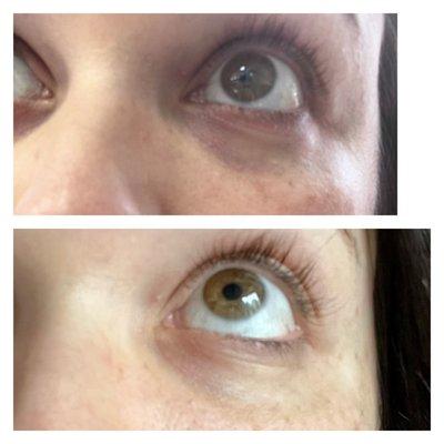 Under eye filler before and after