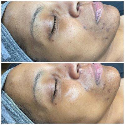 Dermaplane for even skin tone, hyperpigmentation