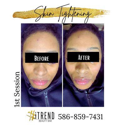 Skin Tightening results after 1 session! These results continue to improve for 7 days post treatment.