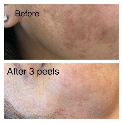 Chemical Peel Results